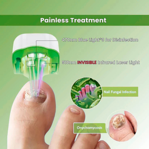 Nail Fungus Laser