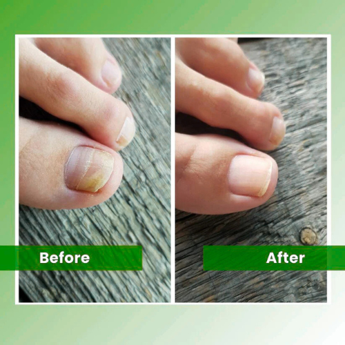 Nail Fungus Laser
