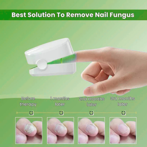 Nail Fungus Laser